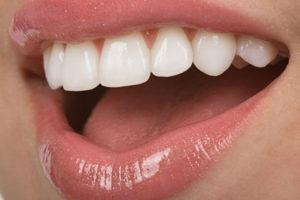 Dentist in Baton Rouge Are Veneers Right for my teeth. Pros and Cons