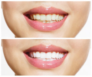 Dentist in Baton Rouge Get That Perfectly White Smile on Your Lunch Break. And No, We’re Not Joking. Dentist in Baton Rouge Get That Perfectly White Smile on Your Lunch Break. And No, We’re Not Joking.
