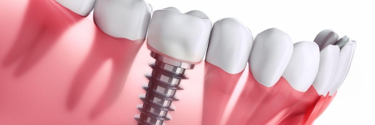 Dentist in Baton Rouge A quick guide to dental implants A quick guide to dental implants